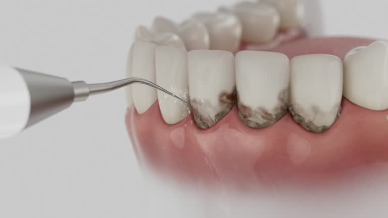 Reliable Wisdom Tooth Removal contractor in Collierville, CA by Smile Center Dentistry